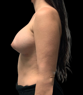 After - Left Lateral