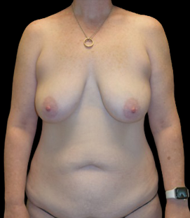 Before - DR11