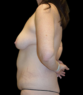 Before - Left Lateral