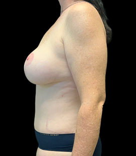 After - Left Lateral