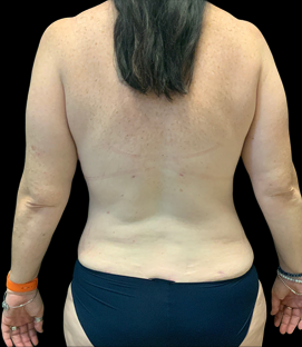 After - Back