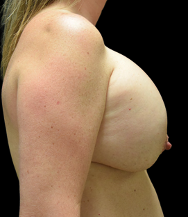 Before - Right Lateral
