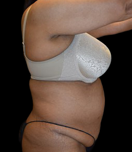 Before - Right Lateral