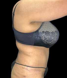 After - Right Lateral