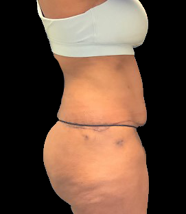 After - Left Lateral