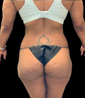 After - Back