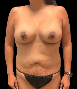 Before - DR31