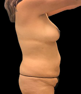 Before - Right Lateral