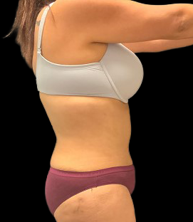 After - Right Lateral