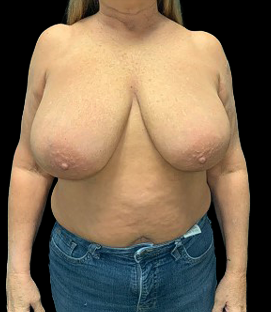 Before - DR34