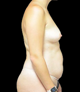Before - Right Lateral