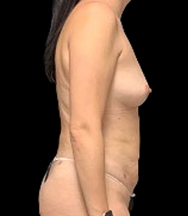 After - Right Lateral
