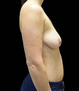 Before - Right Lateral