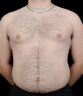 Before - DR41