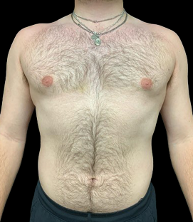 After - DR41