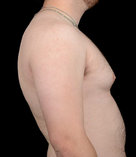 Before - Right Lateral