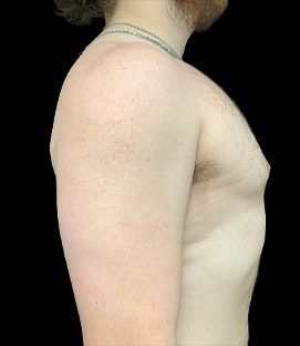 After - Right Lateral