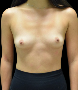Before - DR46