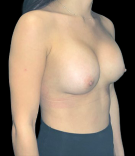 After - Right Oblique