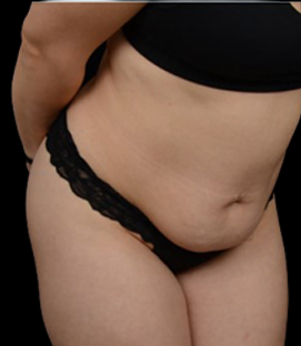 Before - Right Oblique