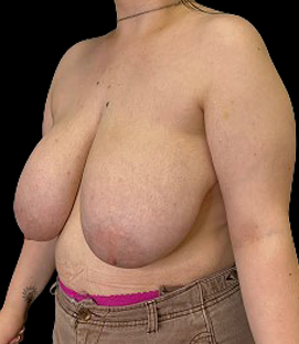 Before - Left Oblique