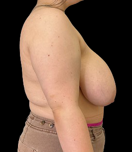 Before - Right Lateral