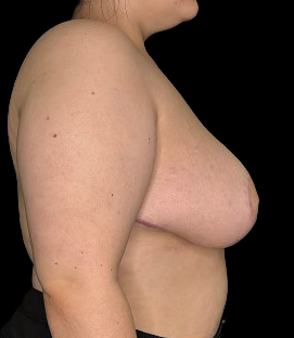After - Right Lateral