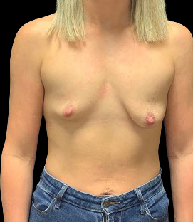 Before - DR58