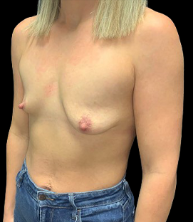 Before - Left Oblique