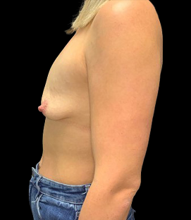 Before - Left Lateral