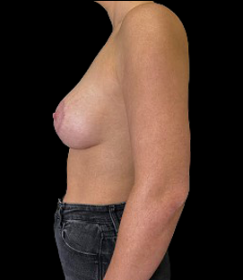 After - Left Lateral