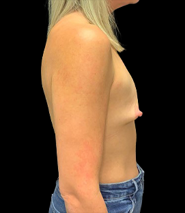 Before - Right Lateral