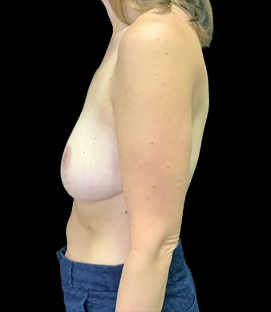 After - Left Lateral
