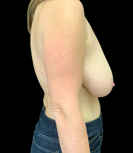 Before - Right Lateral