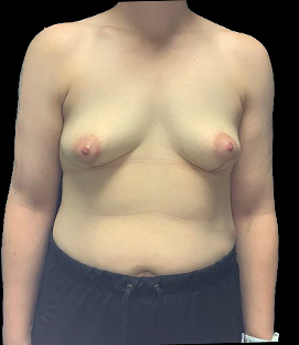 After - DR39