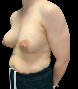 Before - Left Oblique