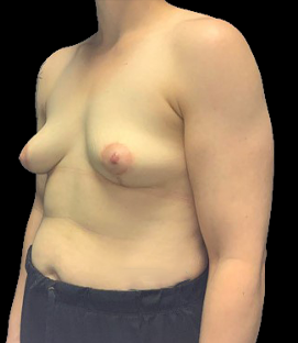 After - Left Oblique