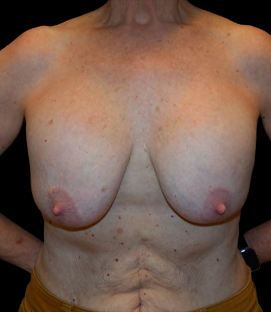 Before - DR54