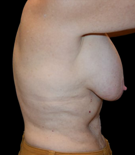 Before - Right Lateral