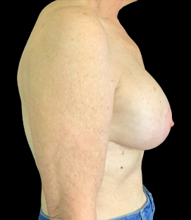 After - Right Lateral