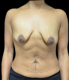 Before - DR48