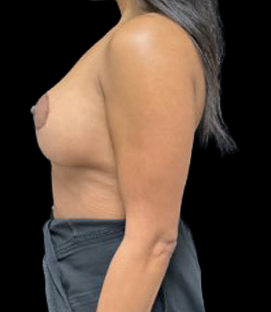 After - Left Lateral
