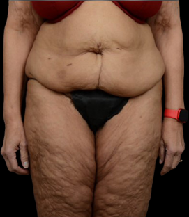 Before - DR59