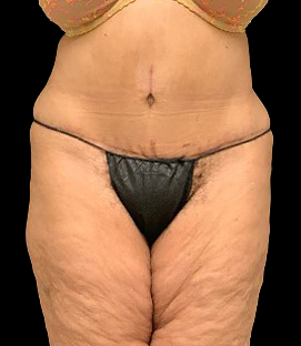 After - DR59