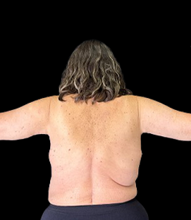 After - Back