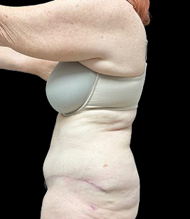 After - Left Lateral